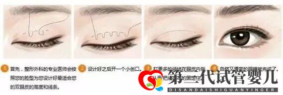 埋线双眼皮恢复期要多少时间?(图1) 埋线双眼皮恢复期要多少时间?(图1)