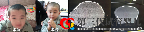 合肥哪家医院可以做颅骨修补术(图1) 合肥哪家医院可以做颅骨修补术(图1)