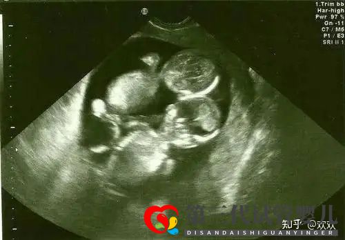 多年不孕,深圳三代试管一次成功双胎男宝(图5)