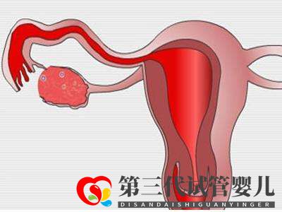 子宫肌瘤做俄罗斯试管婴儿的成功率高吗？(图1)