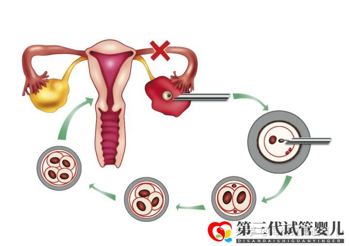 试管婴儿1代、2代、3代、4代哪个最好真实操作过...(图8) 试管婴儿1代、2代、3代、4代哪个最好真实操作过...(图8)