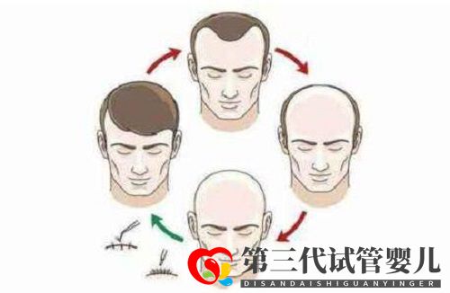 植发可以解决秃顶或头发稀少的问题吗？头发种植多久见效呢？(图1)