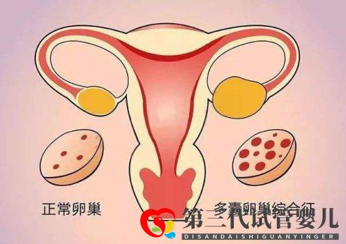 滔滔顾问：试管取卵后怎么解决卵巢过度刺激综合症(图1)