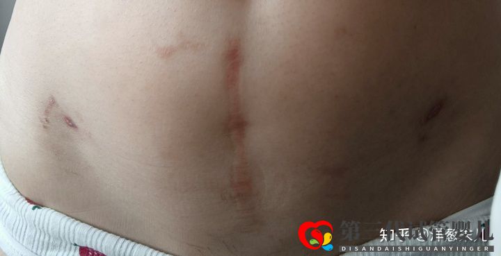 巧囊➕腺肌症➕染色体异位试管路程(图1) 巧囊➕腺肌症➕染色体异位试管路程(图1)