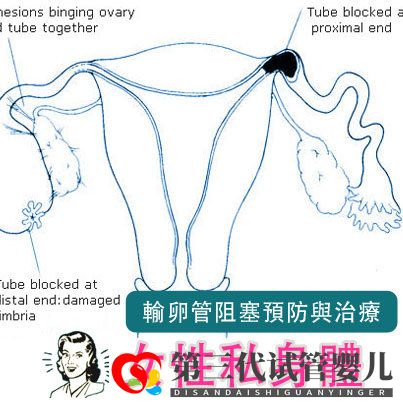 输卵管堵塞,怀孕到底有多难(图2)