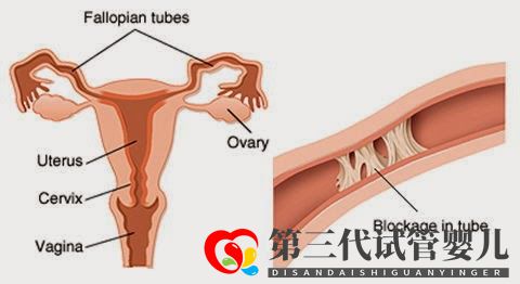 输卵管堵塞,怀孕到底有多难(图3)