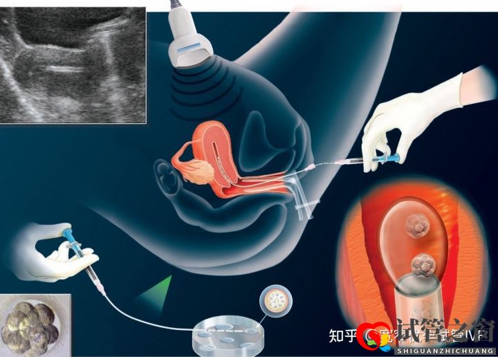 重庆哪里可以做试管婴儿供卵供卵需要多少钱(图4) 重庆哪里可以做试管婴儿供卵供卵需要多少钱(图4)