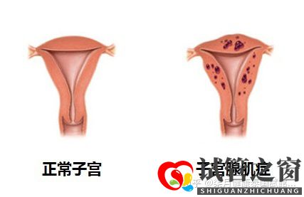 33岁子宫畸形多年未孕,如何提高试管成功率(图2) 33岁子宫畸形多年未孕,如何提高试管成功率(图2)