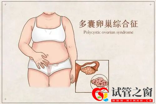如何防止多囊卵巢复发？(图1)