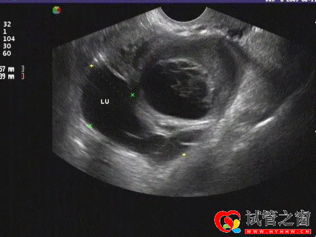 输卵管堵塞三种类型详解，不同程度检查及治疗方法均不同(图1)