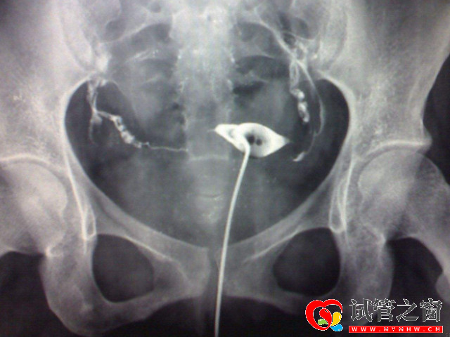 输卵管堵塞三种类型详解，不同程度检查及治疗方法均不同(图3)