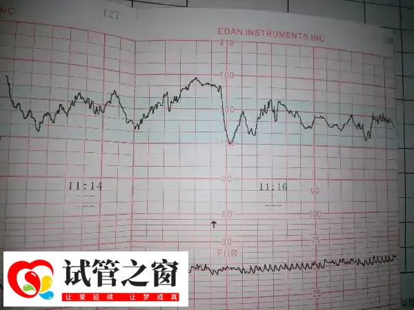 二超的目的是检查胎儿胎心率