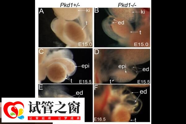 PKD1基因又叫多囊肾相关基因