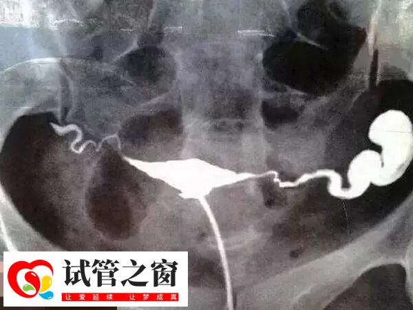 输卵管积水含微生物碎屑等有害物质多