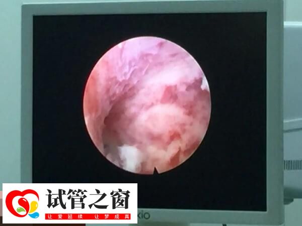 宫腔镜可以确诊宫腔疾病