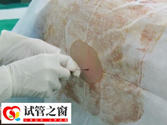 宫腔镜是一种微创性妇科诊疗技术