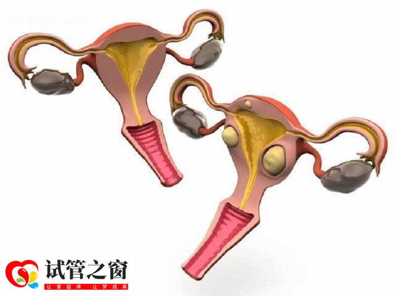 病理性卵巢囊肿不建议做试管婴儿
