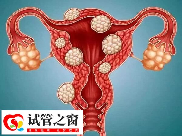 子宫肌瘤过大需要手术切除