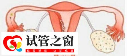 多囊卵巢综合症对日常生活的六大影响？(图1)