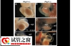 pkd1基因缺失可以生育！做好试管婴儿筛