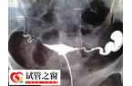 做试管婴儿输卵管积水有影响！易增加宫外孕