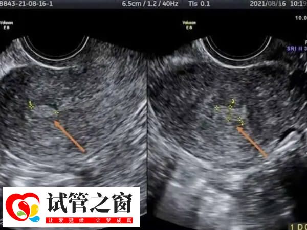 内膜回声不均持续存在有疾病可能