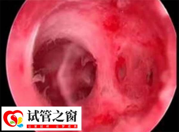 宫腔粘连的症状有哪些(图1) 妊娠异常是宫腔粘连的常见症状之一