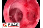 宫腔粘连的症状有哪些